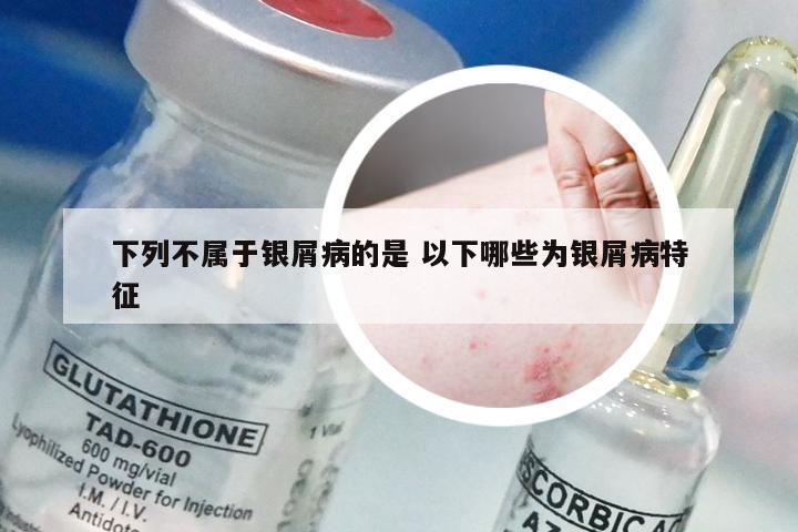 下列不属于银屑病的是 以下哪些为银屑病特征