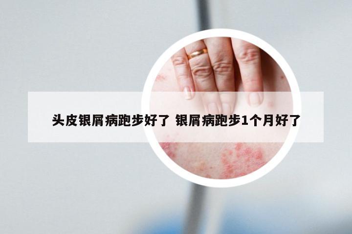 头皮银屑病跑步好了 银屑病跑步1个月好了