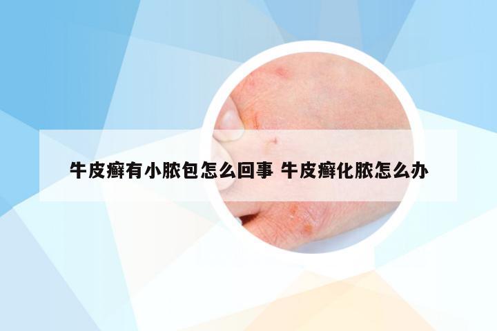 牛皮癣有小脓包怎么回事 牛皮癣化脓怎么办
