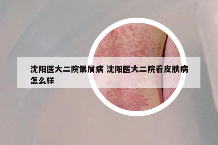 沈阳医大二院银屑病 沈阳医大二院看皮肤病怎么样