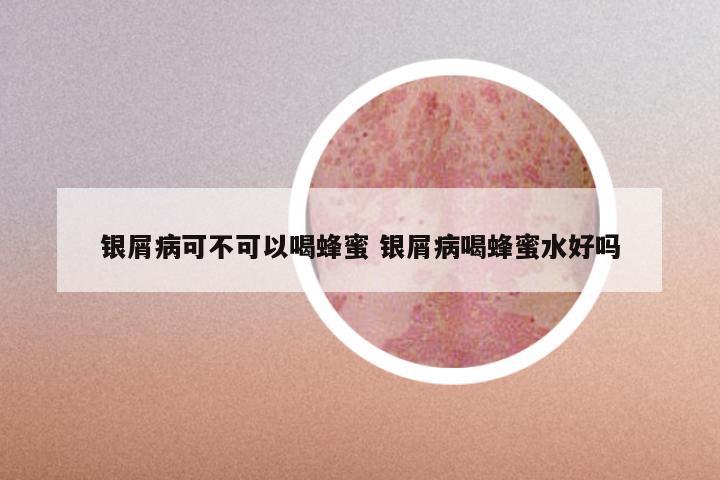 银屑病可不可以喝蜂蜜 银屑病喝蜂蜜水好吗