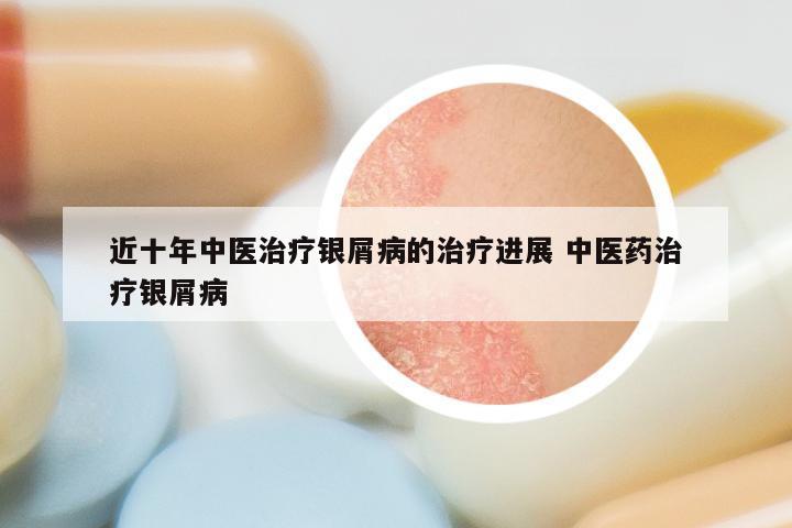 近十年中医治疗银屑病的治疗进展 中医药治疗银屑病