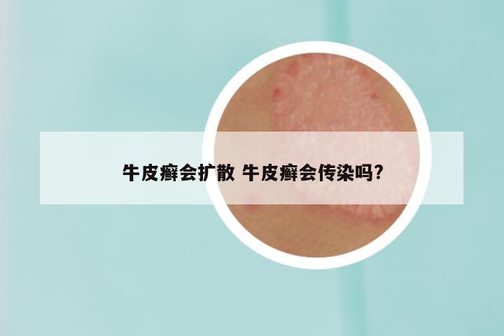 牛皮癣会扩散 牛皮癣会传染吗?