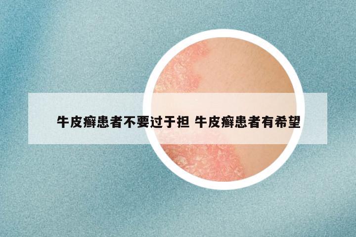 牛皮癣患者不要过于担 牛皮癣患者有希望