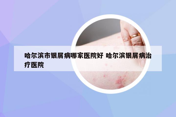 哈尔滨市银屑病哪家医院好 哈尔滨银屑病治疗医院