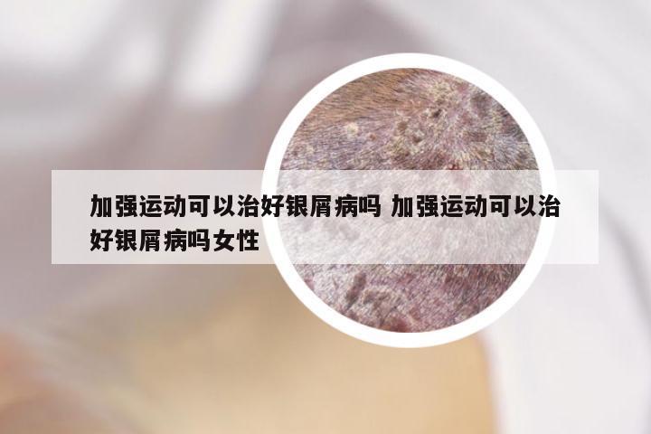 加强运动可以治好银屑病吗 加强运动可以治好银屑病吗女性