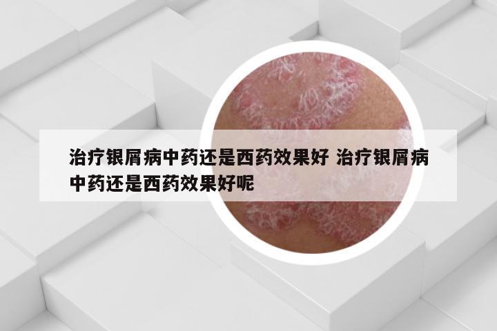 治疗银屑病中药还是西药效果好 治疗银屑病中药还是西药效果好呢