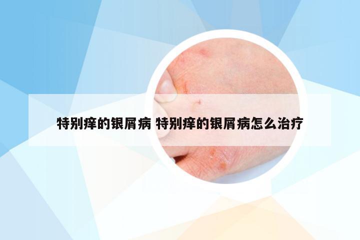 特别痒的银屑病 特别痒的银屑病怎么治疗