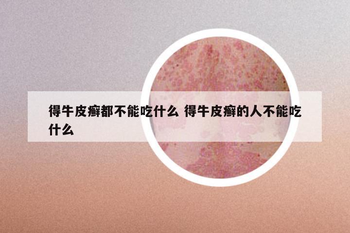 得牛皮癣都不能吃什么 得牛皮癣的人不能吃什么