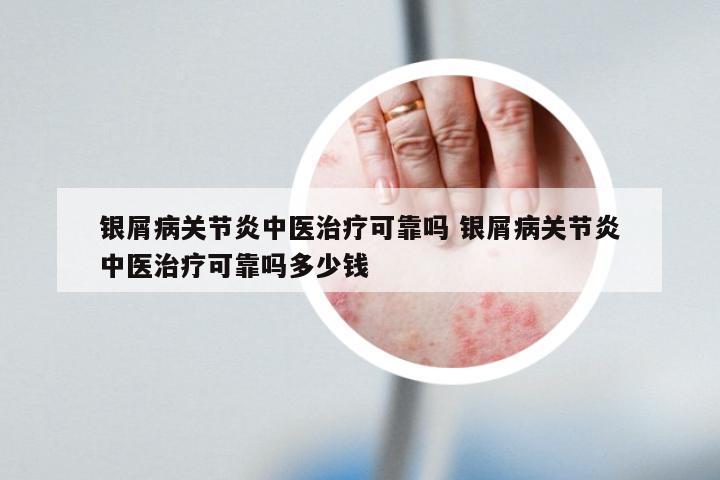 银屑病关节炎中医治疗可靠吗 银屑病关节炎中医治疗可靠吗多少钱