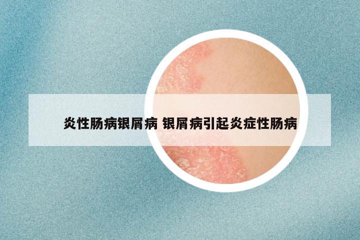 炎性肠病银屑病 银屑病引起炎症性肠病