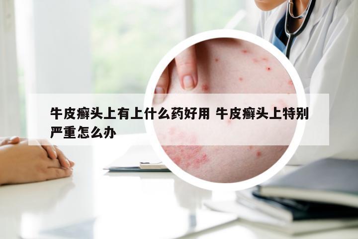 牛皮癣头上有上什么药好用 牛皮癣头上特别严重怎么办