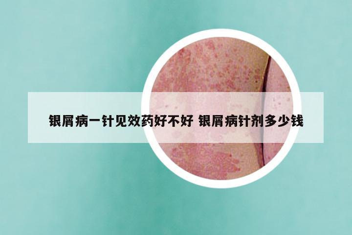 银屑病一针见效药好不好 银屑病针剂多少钱