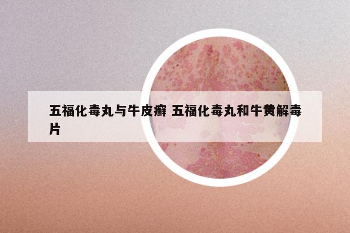 五福化毒丸与牛皮癣 五福化毒丸和牛黄解毒片