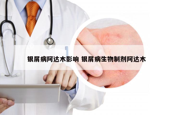 银屑病阿达木影响 银屑病生物制剂阿达木