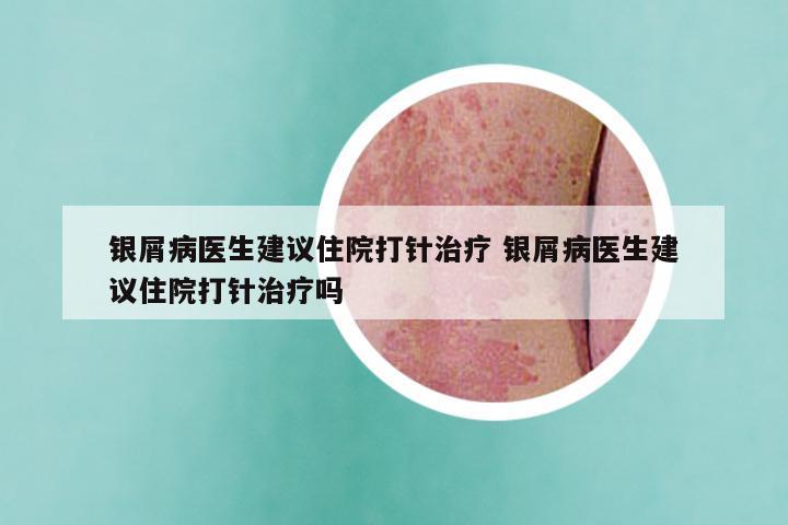 银屑病医生建议住院打针治疗 银屑病医生建议住院打针治疗吗