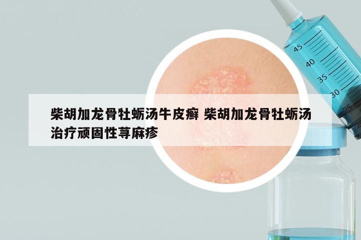 柴胡加龙骨牡蛎汤牛皮癣 柴胡加龙骨牡蛎汤治疗顽固性荨麻疹