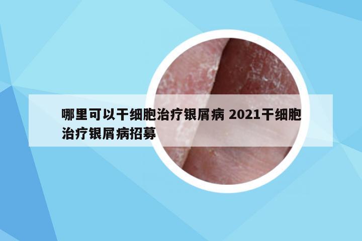 哪里可以干细胞治疗银屑病 2021干细胞治疗银屑病招募