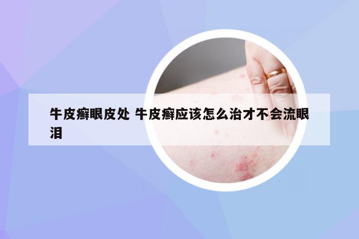 牛皮癣眼皮处 牛皮癣应该怎么治才不会流眼泪