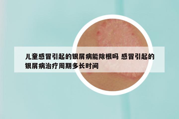 儿童感冒引起的银屑病能除根吗 感冒引起的银屑病治疗周期多长时间