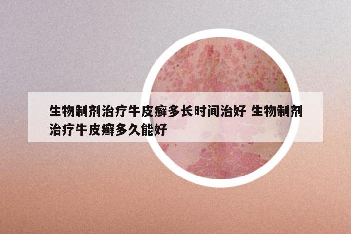 生物制剂治疗牛皮癣多长时间治好 生物制剂治疗牛皮癣多久能好