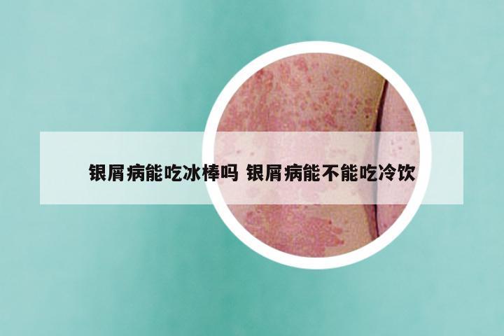 银屑病能吃冰棒吗 银屑病能不能吃冷饮