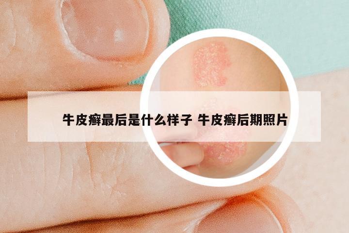 牛皮癣最后是什么样子 牛皮癣后期照片