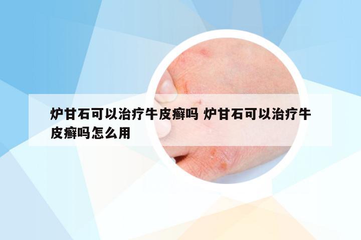 炉甘石可以治疗牛皮癣吗 炉甘石可以治疗牛皮癣吗怎么用