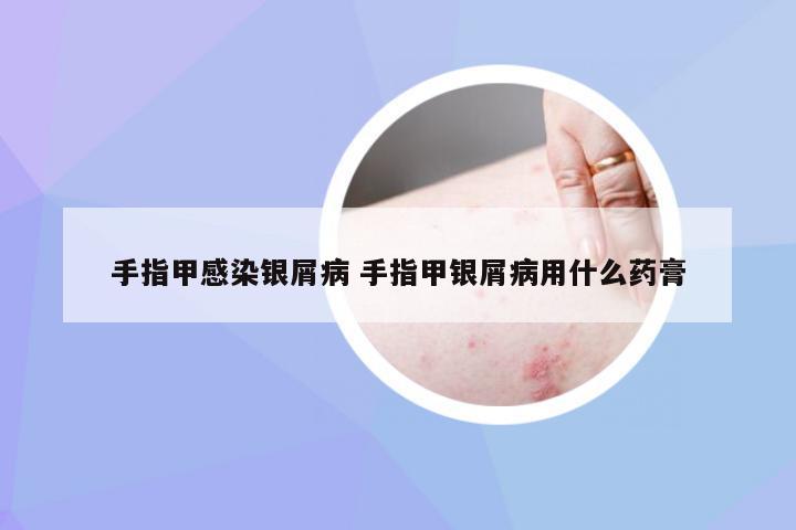 手指甲感染银屑病 手指甲银屑病用什么药膏