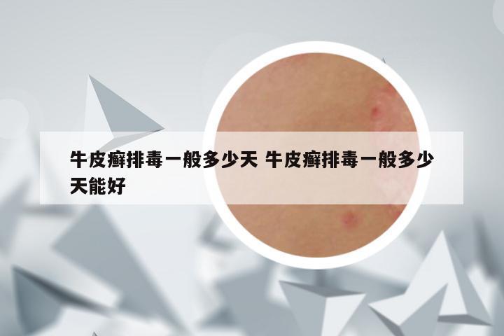 牛皮癣排毒一般多少天 牛皮癣排毒一般多少天能好