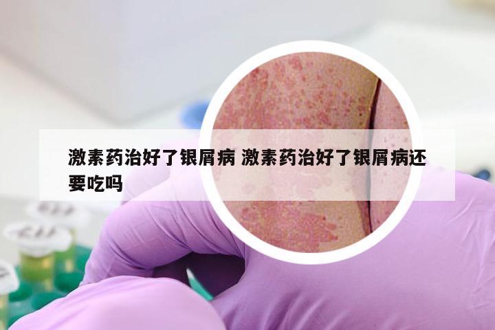 激素药治好了银屑病 激素药治好了银屑病还要吃吗