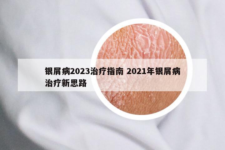 银屑病2023治疗指南 2021年银屑病治疗新思路