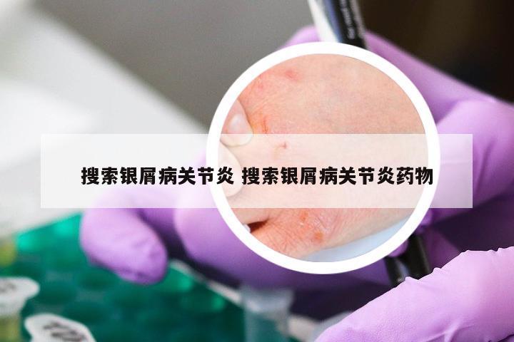 搜索银屑病关节炎 搜索银屑病关节炎药物