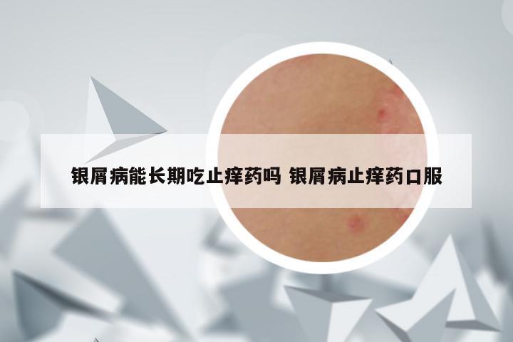 银屑病能长期吃止痒药吗 银屑病止痒药口服