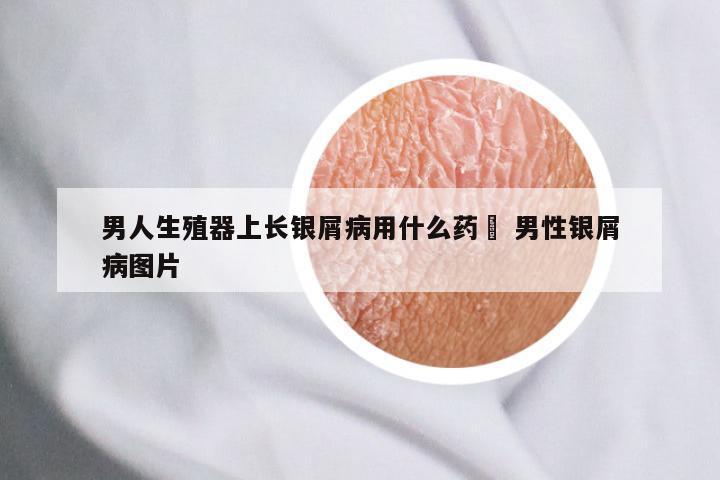男人生殖器上长银屑病用什么药捈 男性银屑病图片