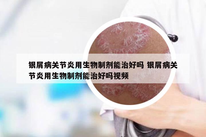 银屑病关节炎用生物制剂能治好吗 银屑病关节炎用生物制剂能治好吗视频