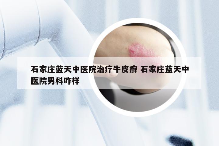 石家庄蓝天中医院治疗牛皮癣 石家庄蓝天中医院男科咋样