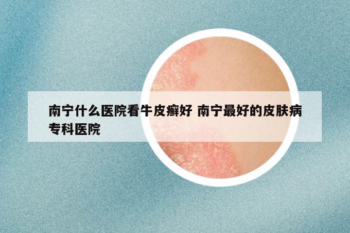 南宁什么医院看牛皮癣好 南宁最好的皮肤病专科医院