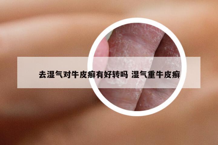 去湿气对牛皮癣有好转吗 湿气重牛皮癣