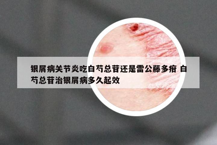 银屑病关节炎吃白芍总苷还是雷公藤多疳 白芍总苷治银屑病多久起效