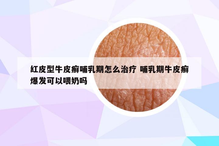 红皮型牛皮癣哺乳期怎么治疗 哺乳期牛皮癣爆发可以喂奶吗