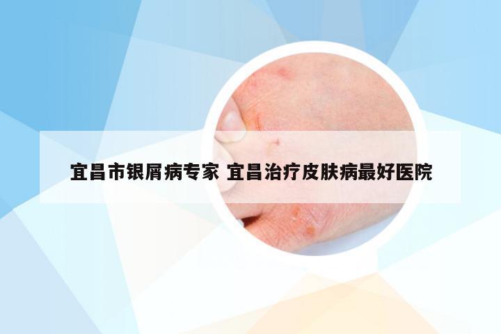 宜昌市银屑病专家 宜昌治疗皮肤病最好医院