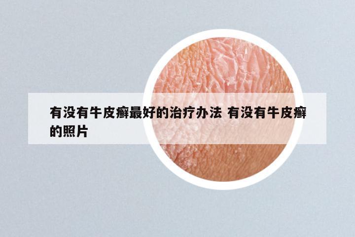 有没有牛皮癣最好的治疗办法 有没有牛皮癣的照片