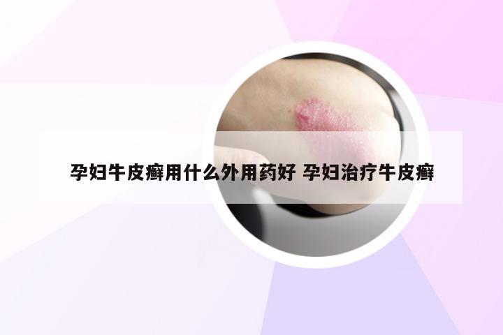 孕妇牛皮癣用什么外用药好 孕妇治疗牛皮癣