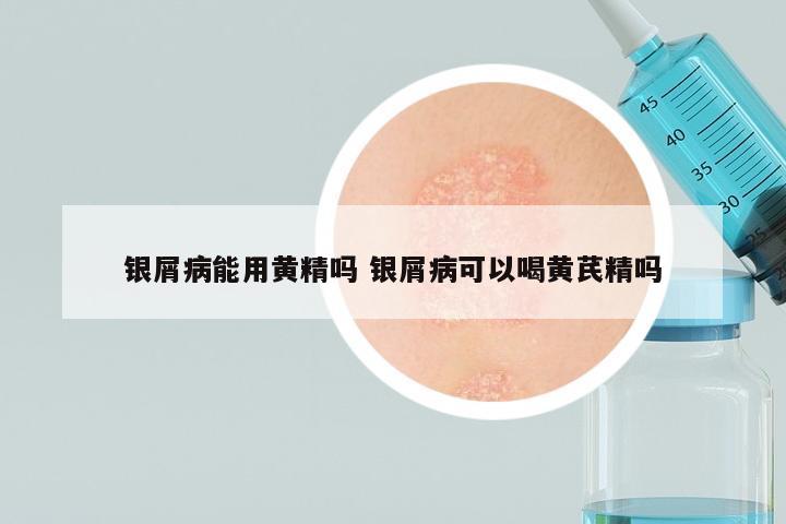 银屑病能用黄精吗 银屑病可以喝黄芪精吗