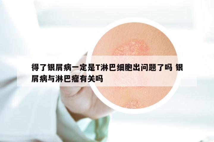得了银屑病一定是T淋巴细胞出问题了吗 银屑病与淋巴瘤有关吗