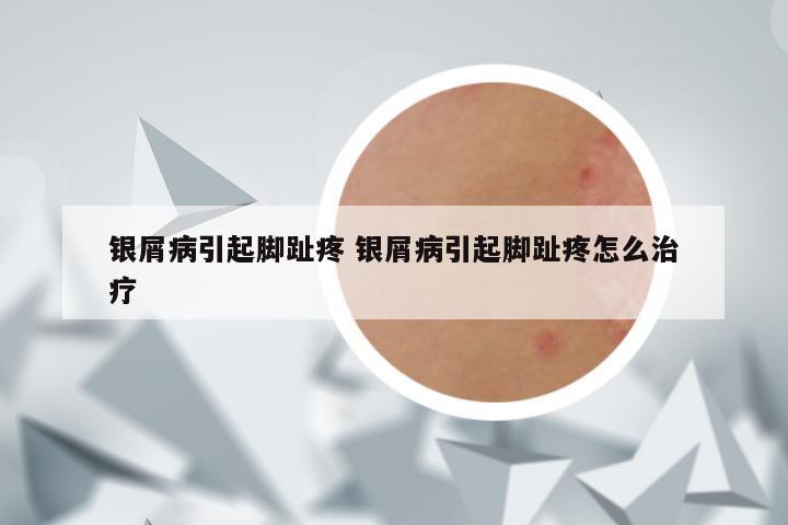 银屑病引起脚趾疼 银屑病引起脚趾疼怎么治疗