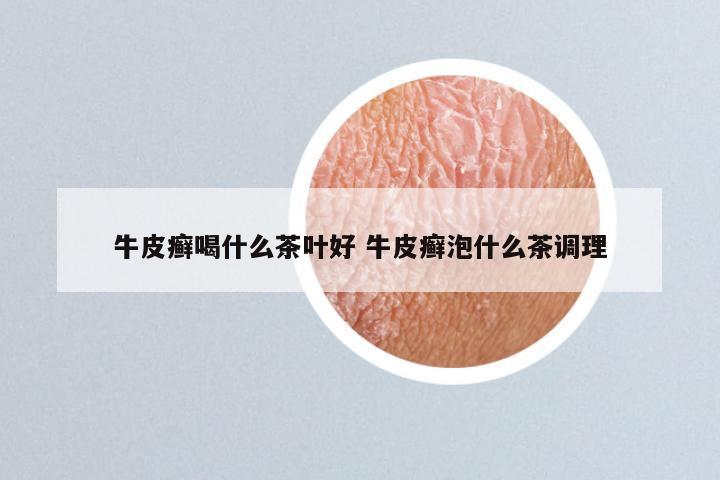 牛皮癣喝什么茶叶好 牛皮癣泡什么茶调理