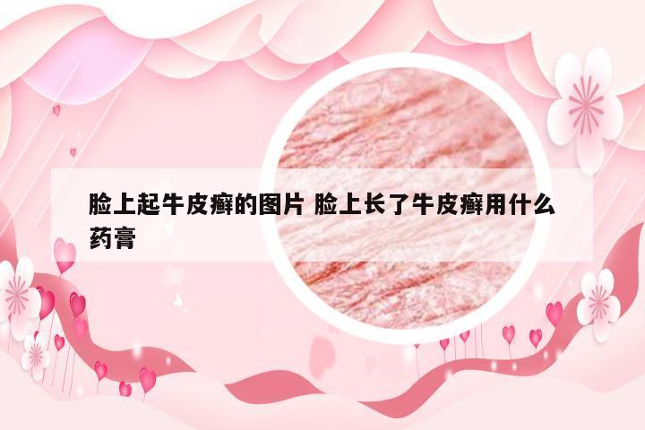脸上起牛皮癣的图片 脸上长了牛皮癣用什么药膏