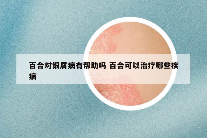 百合对银屑病有帮助吗 百合可以治疗哪些疾病